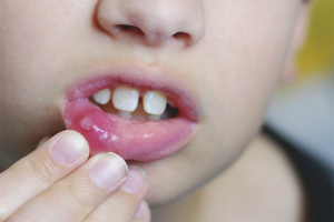 Hoe stomatitis bij een kind te behandelen