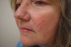 Hoe rosacea op het gezicht te behandelen