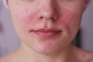 Hoe rosacea op het gezicht te verwijderen