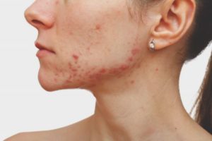 Acne op de kin bij vrouwen