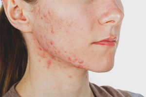 Acne op de jukbeenderen van vrouwen