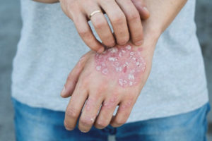 Hoe psoriasis te behandelen