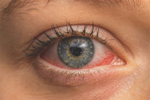 conjunctivitis